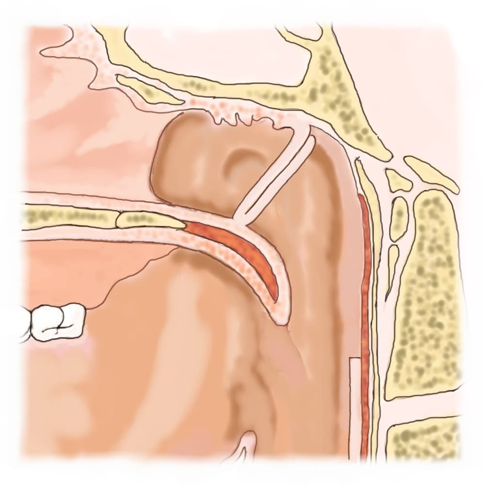 形成外科論文に掲載された手術シェーマ JPRAS Open (2017)