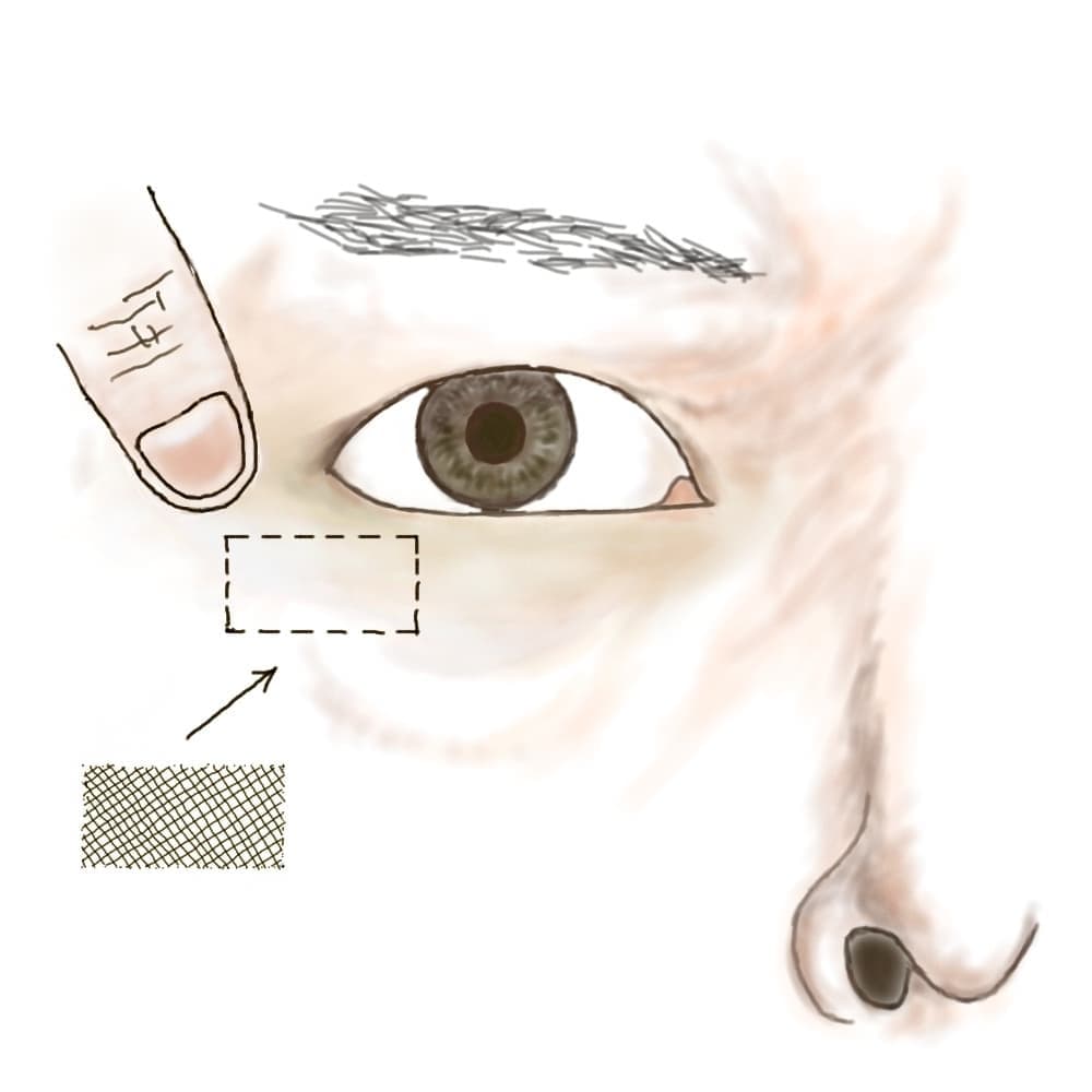 形成外科論文に掲載された手術シェーマ PRS Global Open (2016)